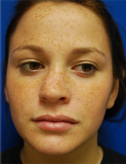 Rhinoplasty Before & After Patient #5810