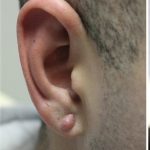 Earlobe Repair Before & After Patient #6260