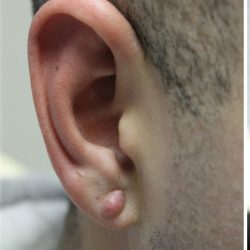Earlobe Repair Before & After Patient #6260