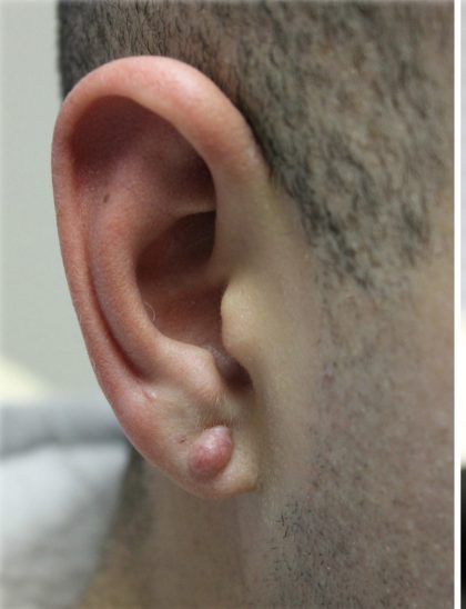 Earlobe Repair Before & After Patient #6260