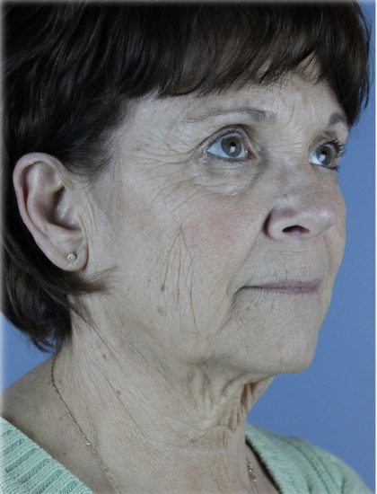 Fat Grafting Before & After Patient #5156