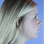 Neck Liposuction Before & After Patient #5301