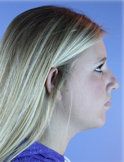Neck Liposuction Before & After Patient #5301