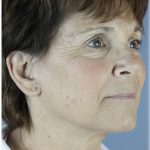 Fat Grafting Before & After Patient #5156