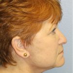 QuickLift Before & After Patient #5375