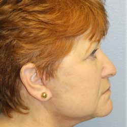 QuickLift Before & After Patient #5375