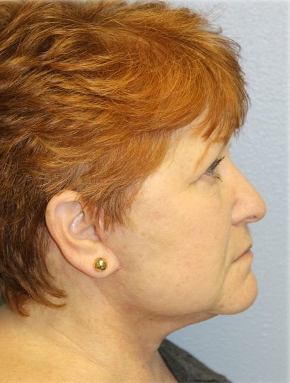 QuickLift Before & After Patient #5375