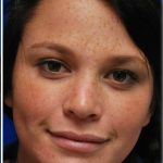 Rhinoplasty Before & After Patient #5810