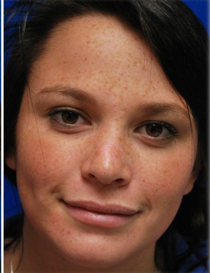 Rhinoplasty Before & After Patient #5810