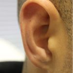 Earlobe Repair Before & After Patient #6260