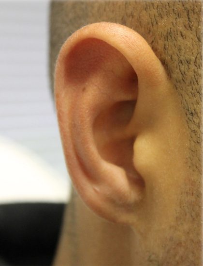 Earlobe Repair Before & After Patient #6260
