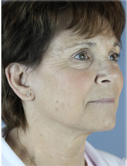 Fat Grafting Before & After Patient #5156