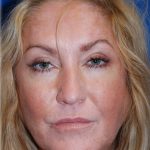 Cheek Augmentation Before & After Patient #77