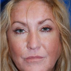 Cheek Augmentation Before & After Patient #77