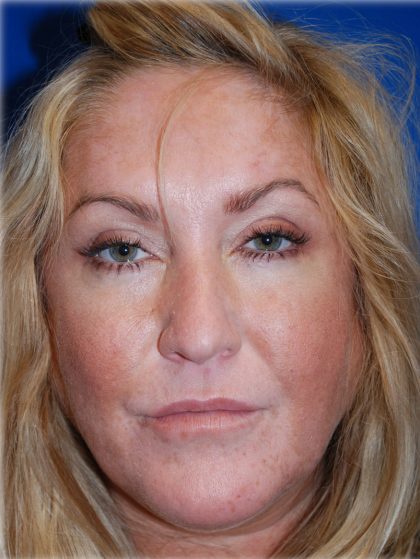 Cheek Augmentation Before & After Patient #77