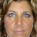 Brow Lift Before & After Patient #65