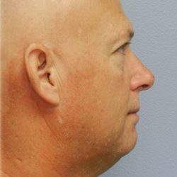 Chin Augmentation Before & After Patient #98