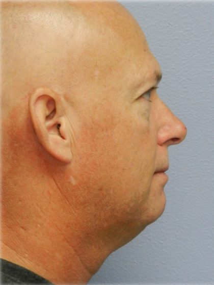 Chin Augmentation Before & After Patient #98