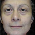 Quad Blepharoplasty Before & After Patient #121