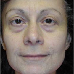 Quad Blepharoplasty Before & After Patient #121
