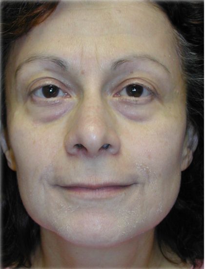 Quad Blepharoplasty Before & After Patient #121