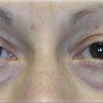 Quad Blepharoplasty Before & After Patient #122