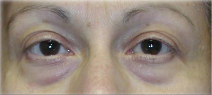 Quad Blepharoplasty Before & After Patient #122