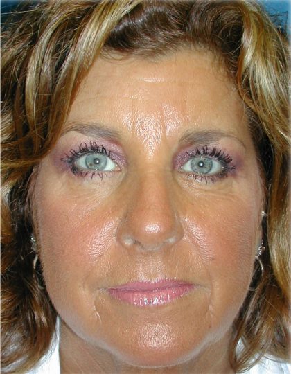 Brow Lift Before & After Patient #65