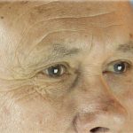 Lower Blepharoplasty Before & After Patient #127