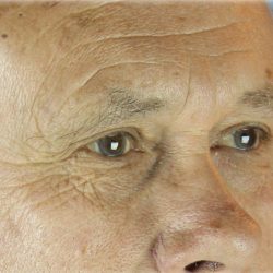 Lower Blepharoplasty Before & After Patient #127