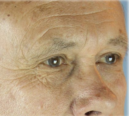 Lower Blepharoplasty Before & After Patient #127