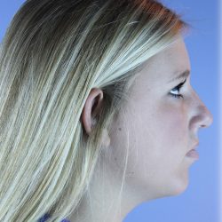 Chin Augmentation Before & After Patient #83