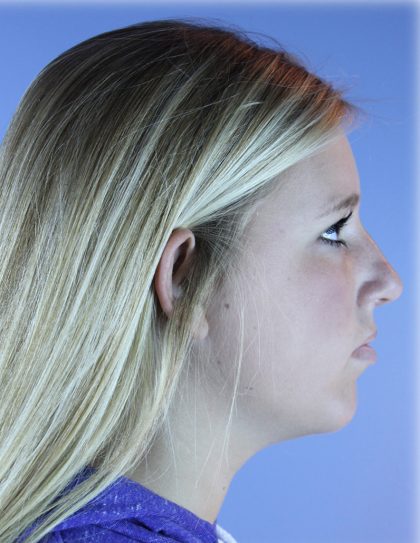 Chin Augmentation Before & After Patient #83