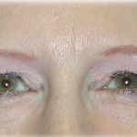 Upper Blepharoplasty Before & After Patient #128