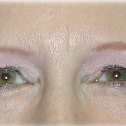 Upper Blepharoplasty Before & After Patient #128