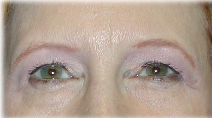 Upper Blepharoplasty Before & After Patient #128