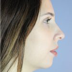 Chin Augmentation Before & After Patient #96