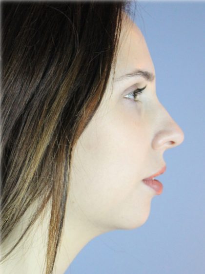 Chin Augmentation Before & After Patient #96