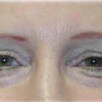 Upper Blepharoplasty Before & After Patient #128
