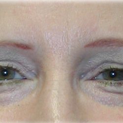 Upper Blepharoplasty Before & After Patient #128