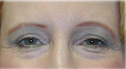 Upper Blepharoplasty Before & After Patient #128