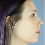 Chin Augmentation Before & After Patient #96