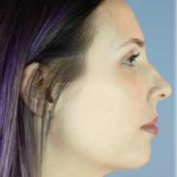 Chin Augmentation Before & After Patient #96