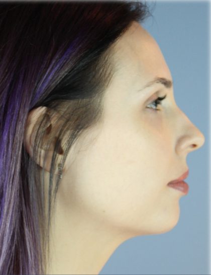 Chin Augmentation Before & After Patient #96