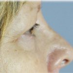 Upper Blepharoplasty Before & After Patient #129
