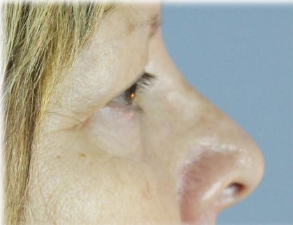 Upper Blepharoplasty Before & After Patient #129