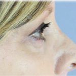 Upper Blepharoplasty Before & After Patient #129