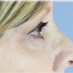 Upper Blepharoplasty Before & After Patient #129