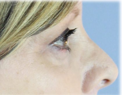 Upper Blepharoplasty Before & After Patient #129