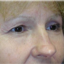 Upper Blepharoplasty Before & After Patient #130